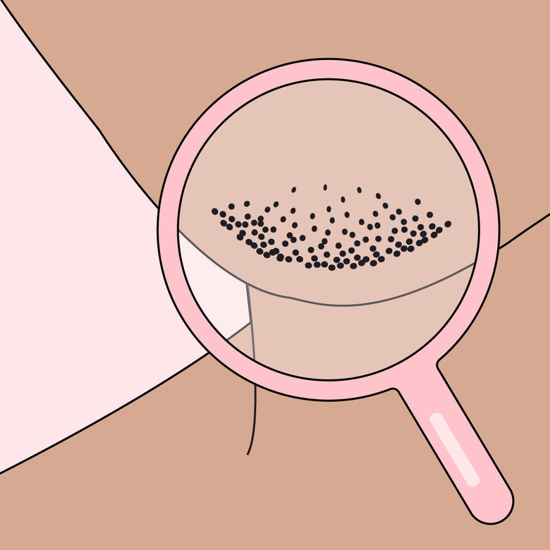 close up illustration of facial hair caused by PCOS